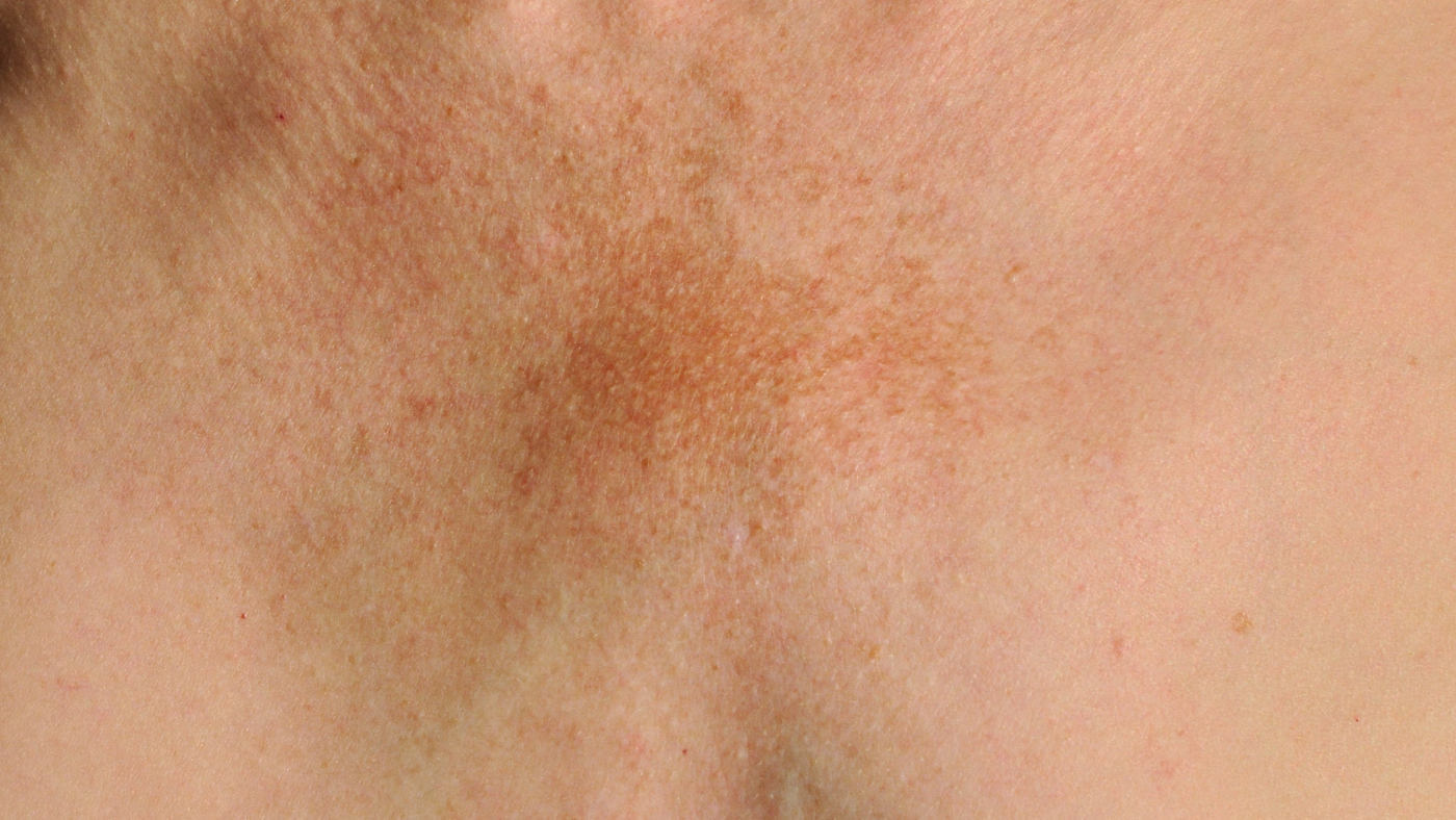 Eczema