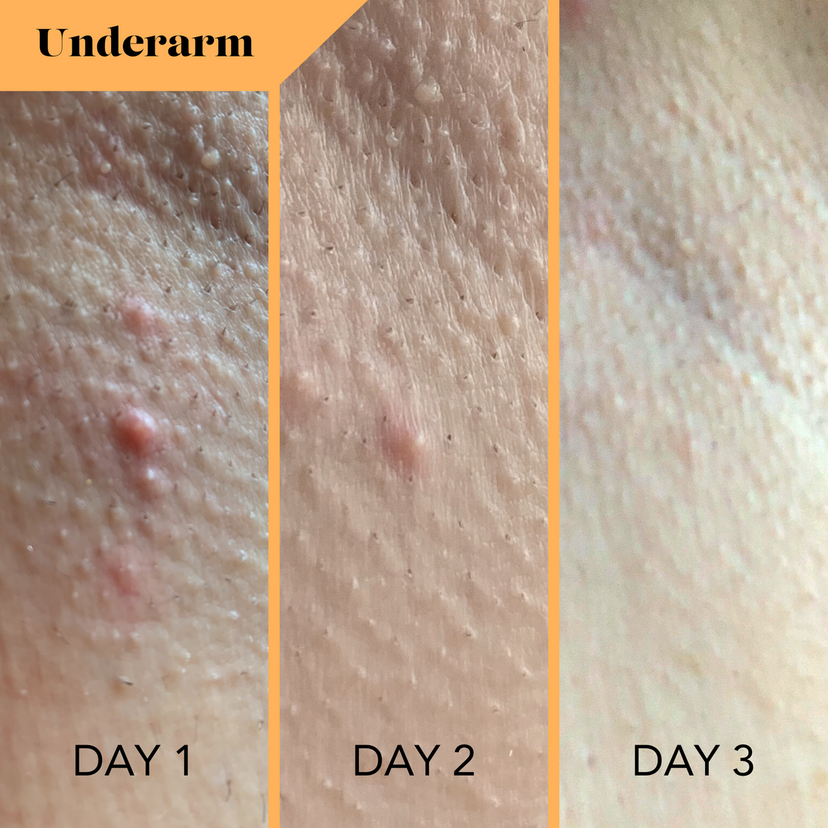 Bikini & Body Bump Eraser - Razor Bumps & Dark Spots Remover Cream